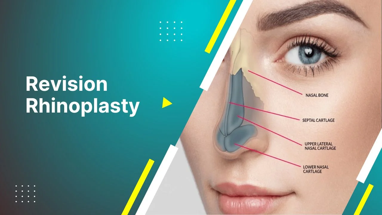 Revision rhinoplasty