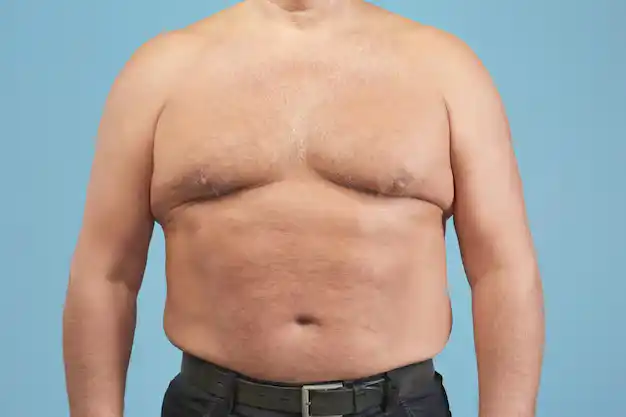 Gynécomastie 6 Gynecomastia Turkey Istanbul 7