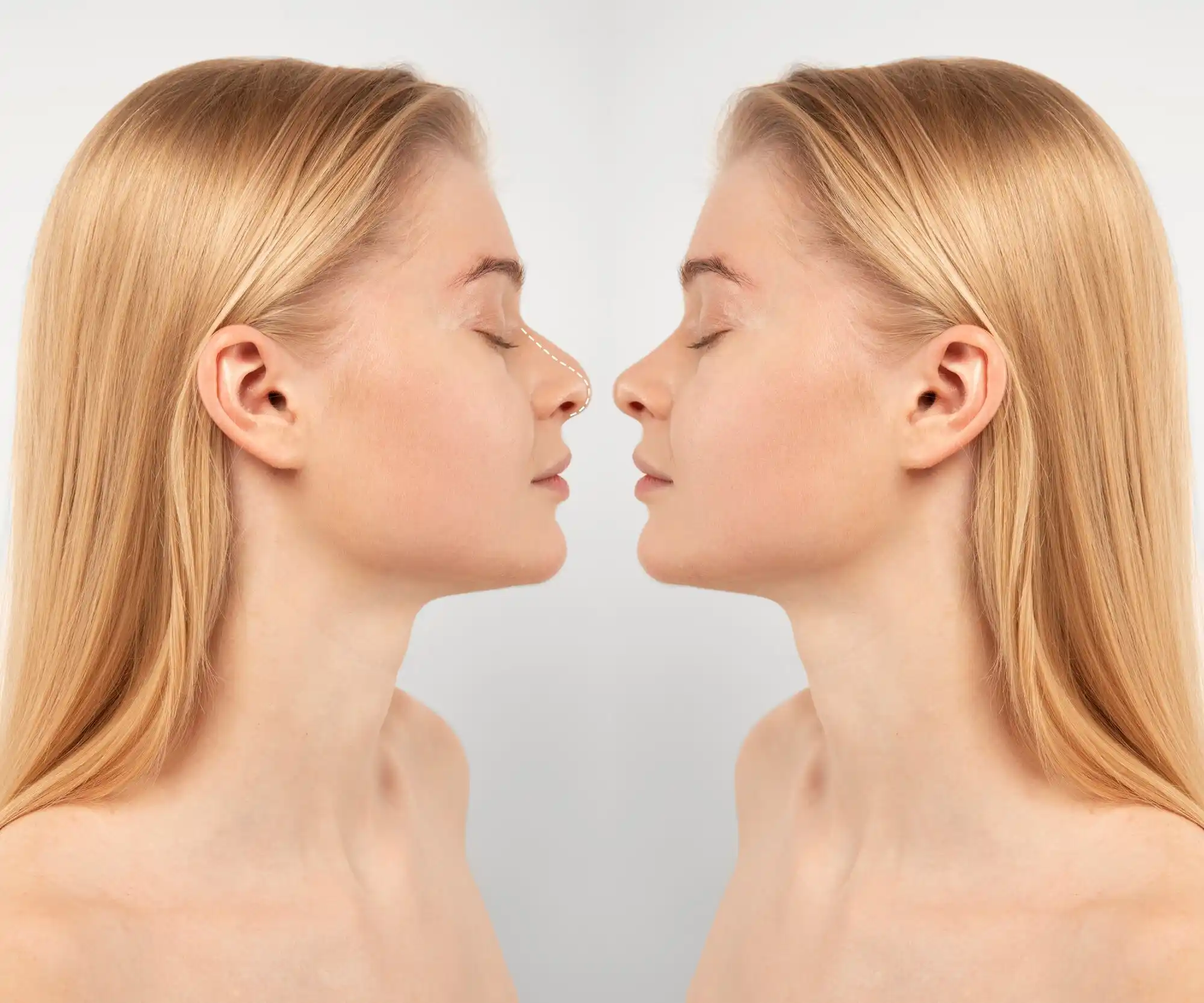 Nasenkorrektur 10 Turkey Istanbul Rhinoplasty 8