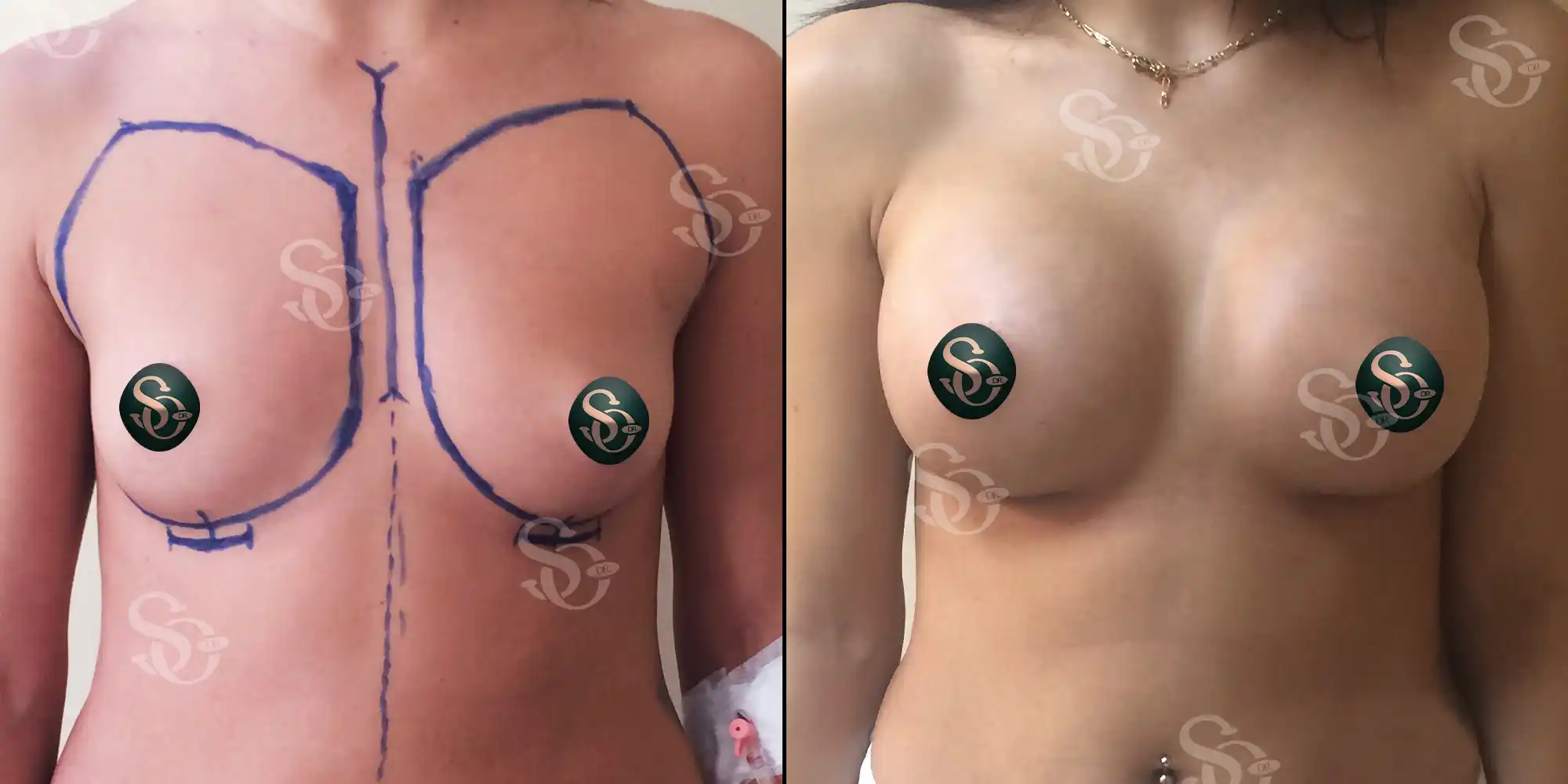 Best Breast Implant Augmentation before after 3