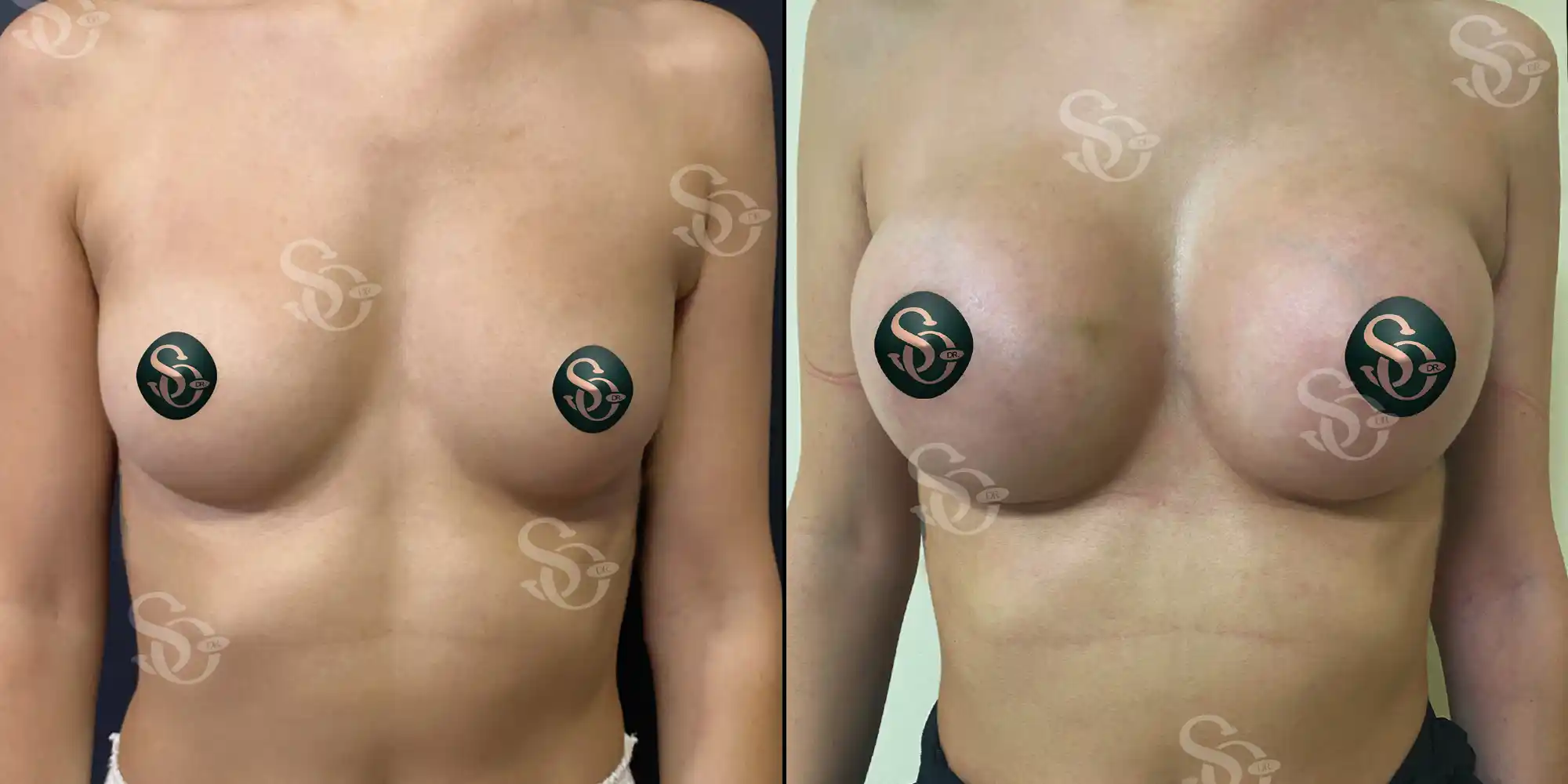 Best Breast Implant Augmentation before after 4