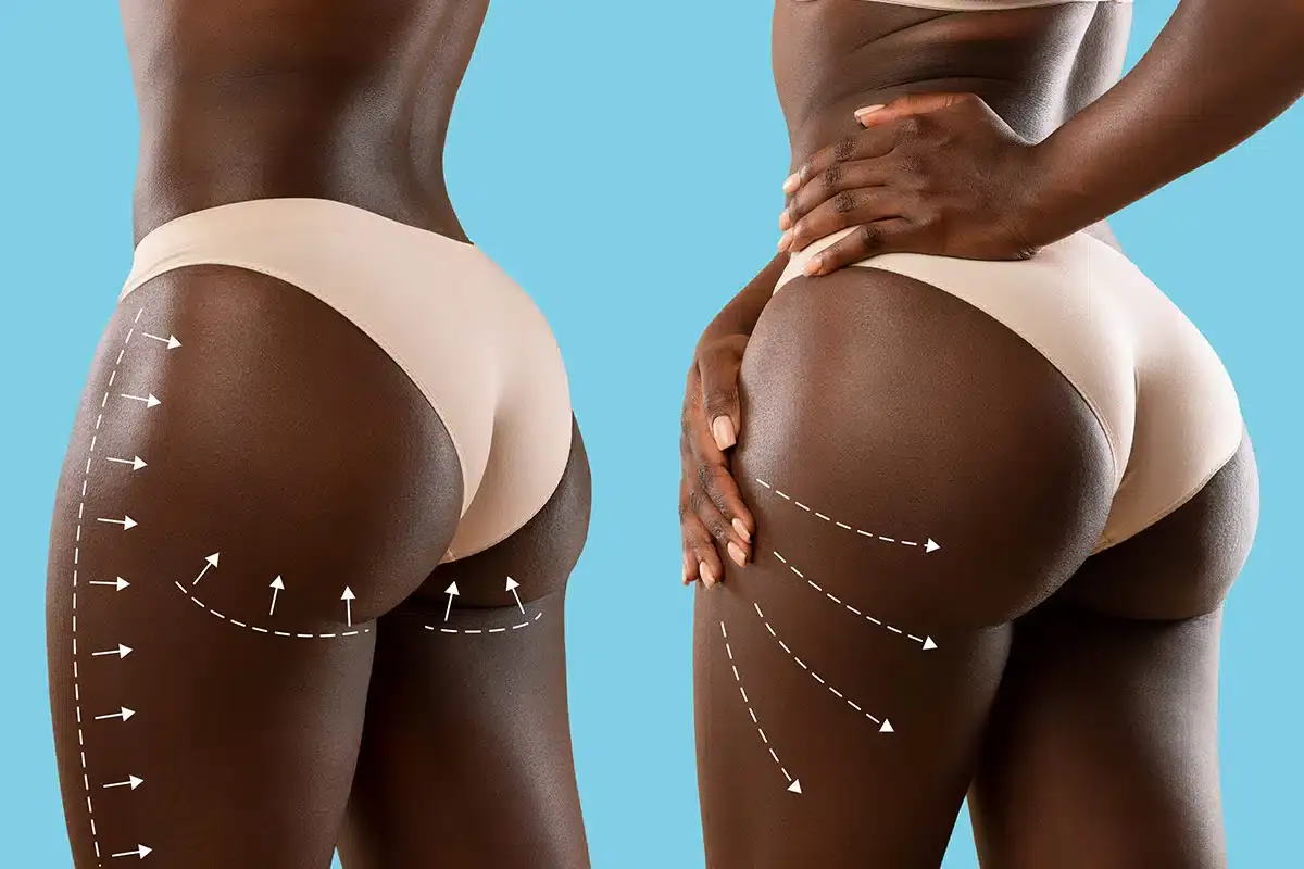 Ideal Buttocks with Buttock Lift Surgery 1 Brazilian Butt Lift BBL Achieving the Curves You Desire
