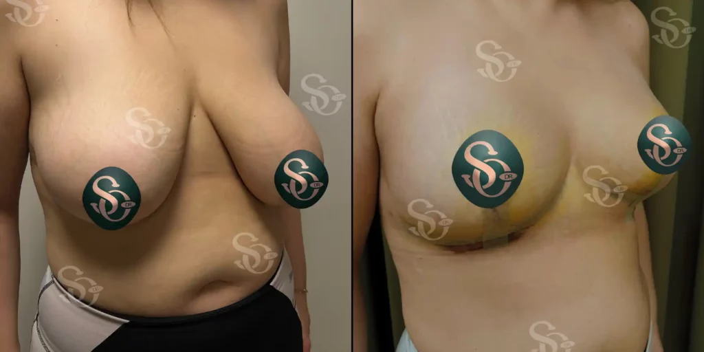 Breast Reduction Istanbul Turkey 3 1 1024x512 3