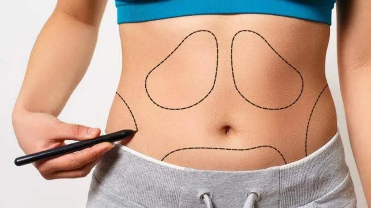 Can Liposuction Reduce Belly Fat A Comprehensive Guide to Targeting Abdominal Fat 1536x864 1
