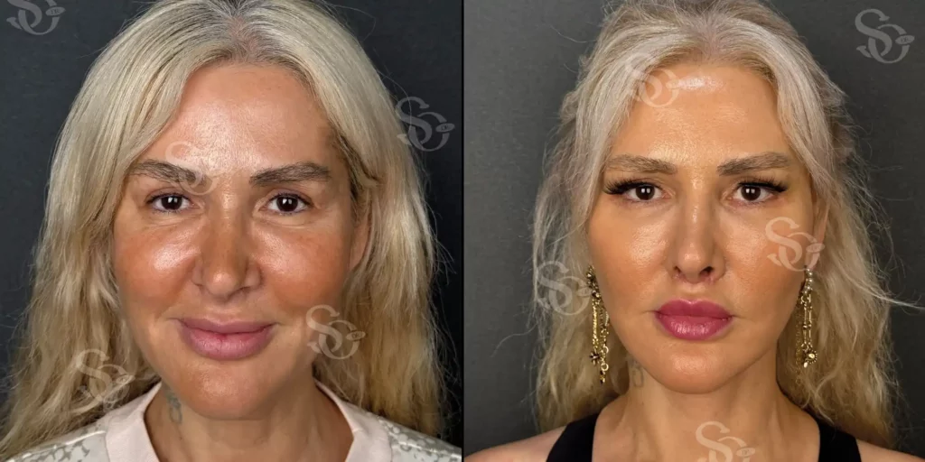 Facelift Istanbul Turkey before after 2 1024x512 2