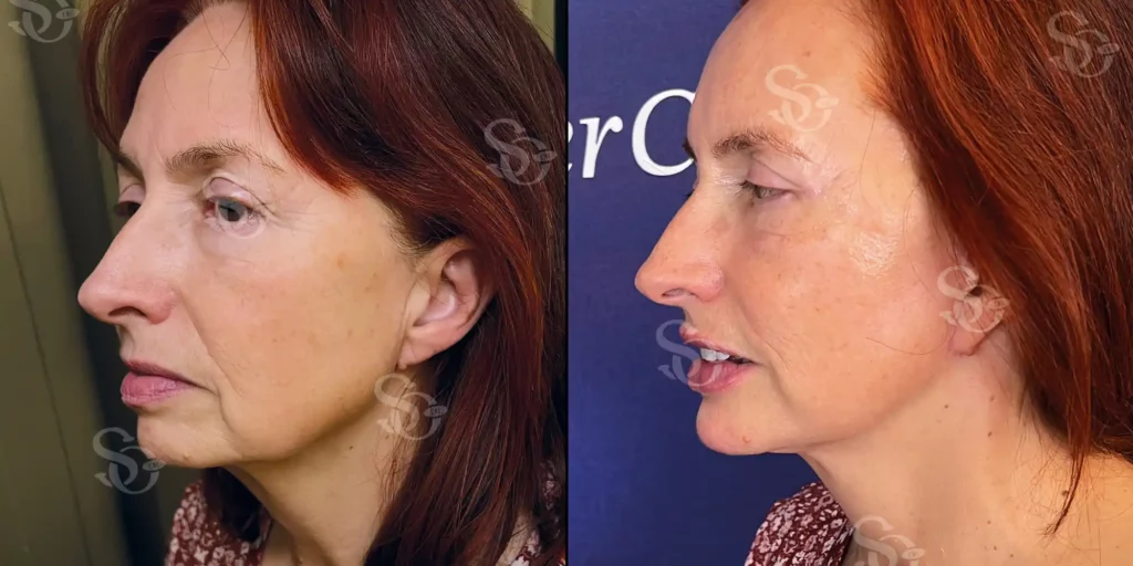 Facelift Istanbul Turkey before after 4 1024x512 2