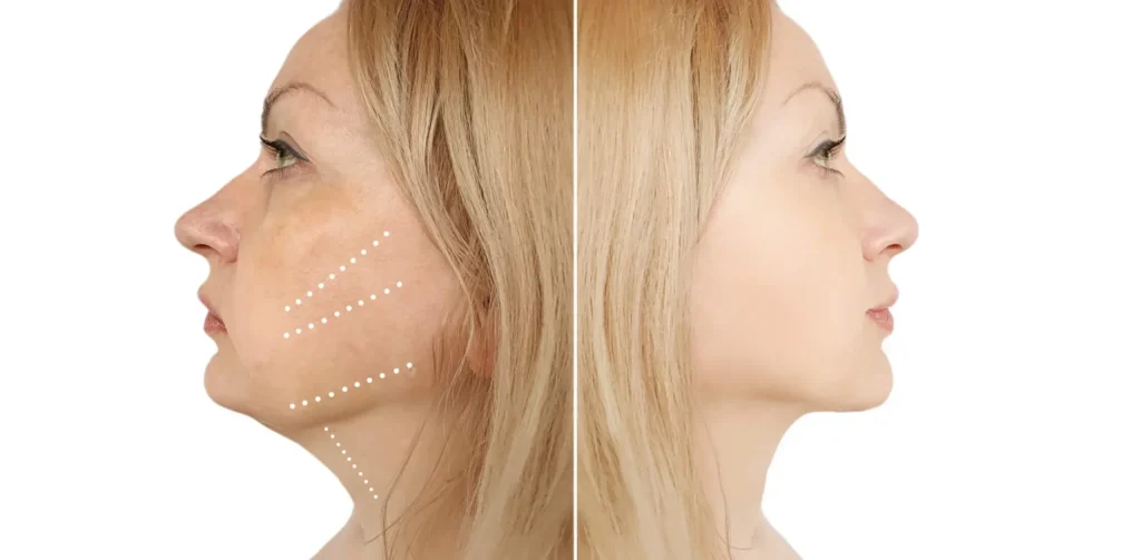 Who is a Good Candidate for Neck Lift Surgery? 4 Neck Lift scaled 1 1536x755 1