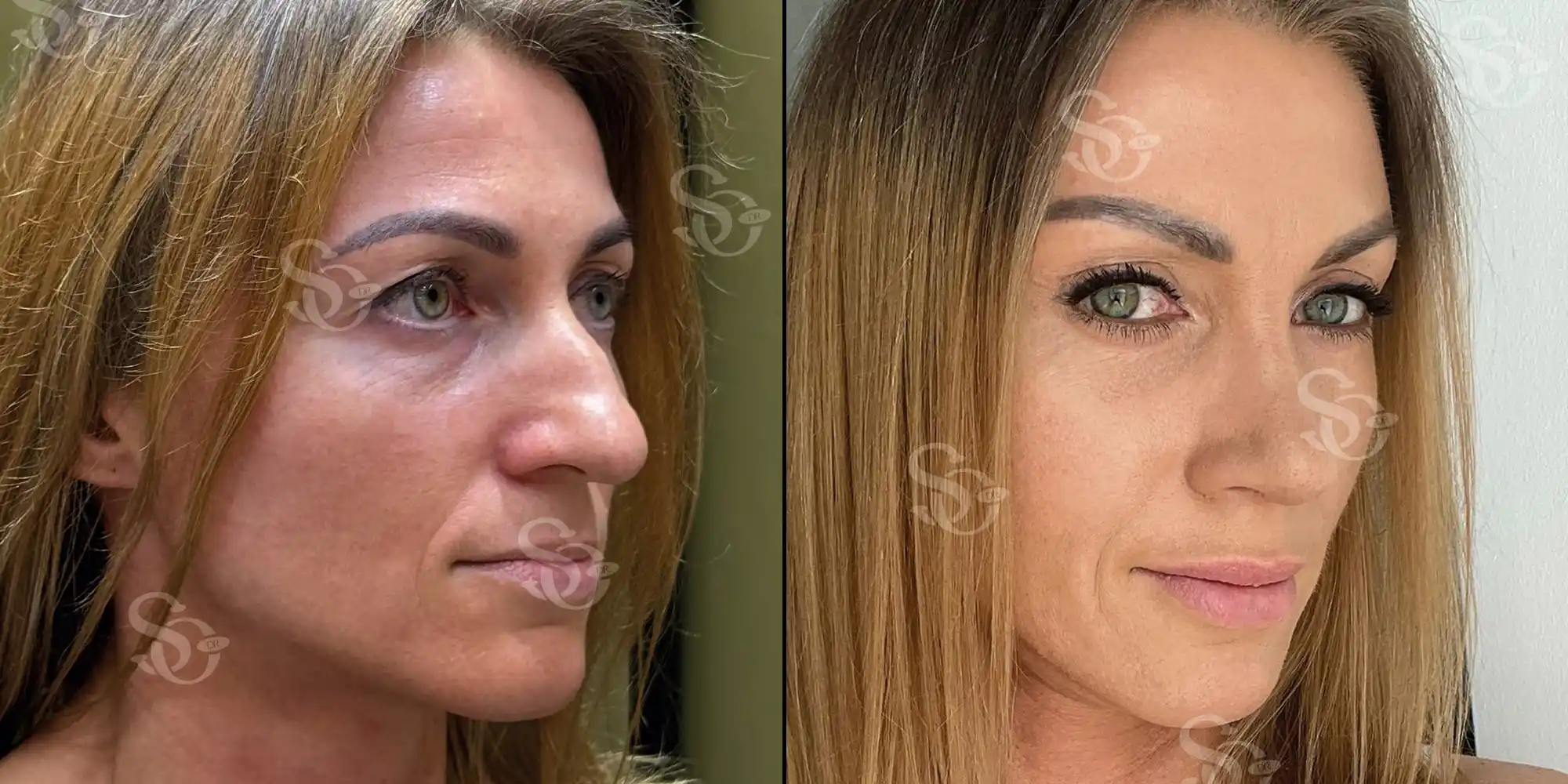 Rhinoplastie ethnique 5 Rhinoplasty before after turkey 1 2