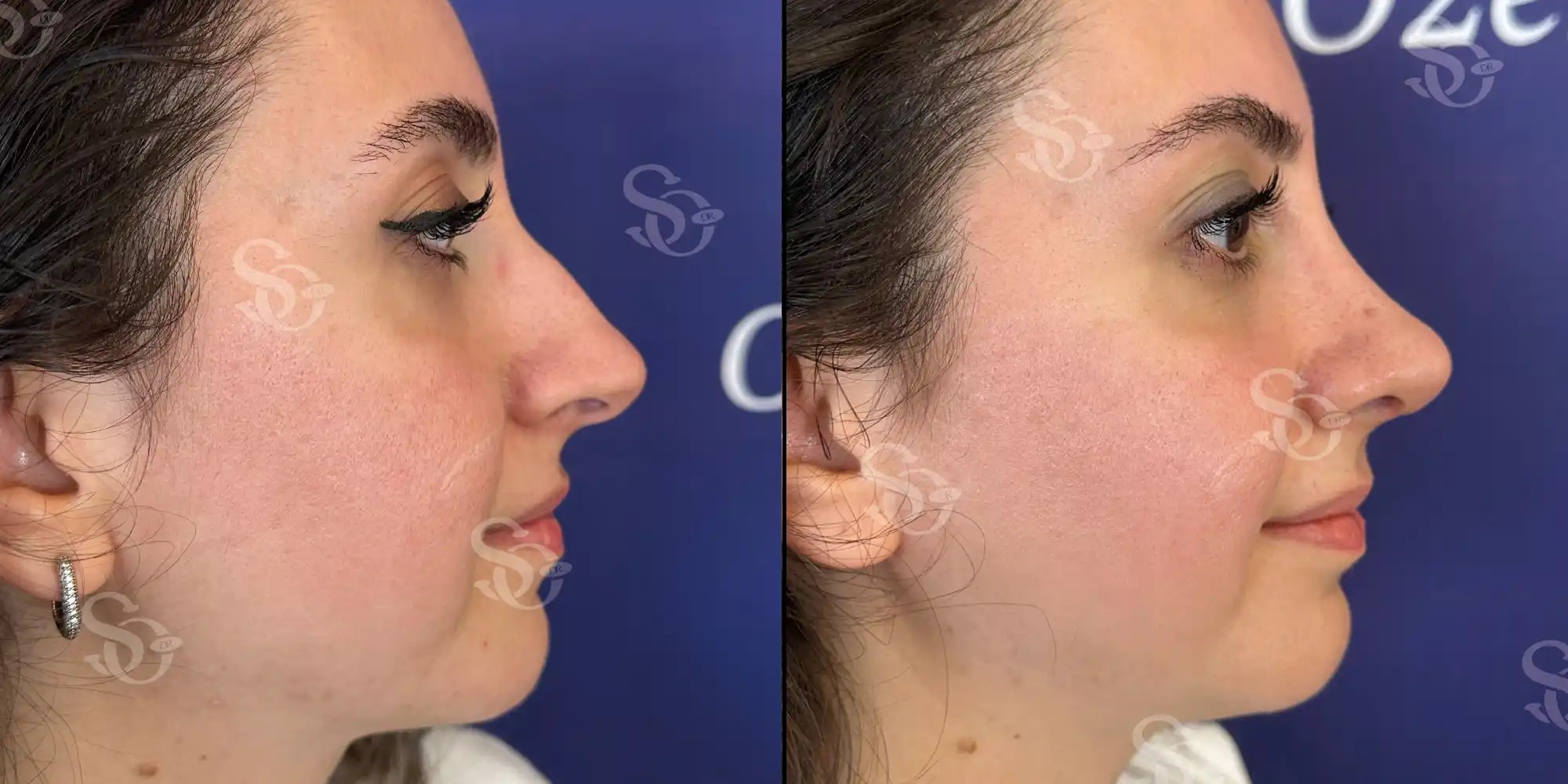 Rhinoplasty before after turkey 3 4