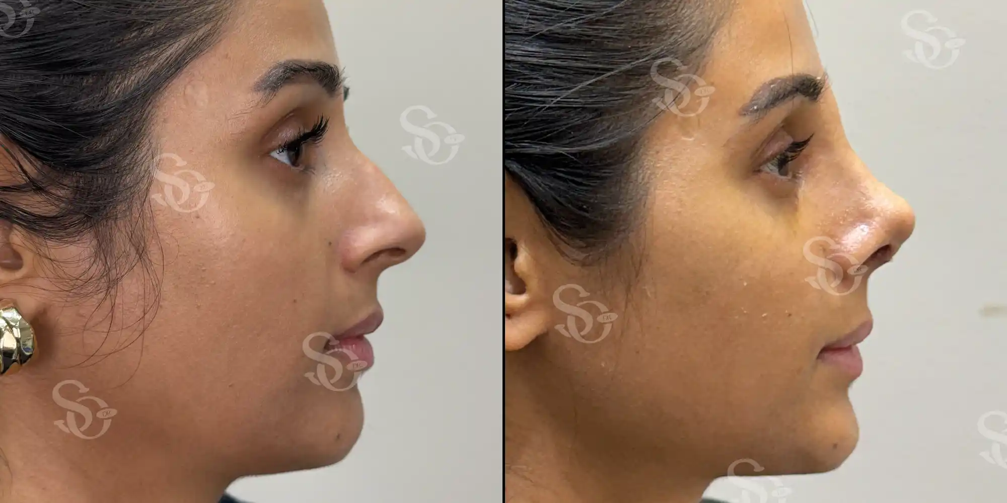 Rhinoplasty before after turkey 4 4