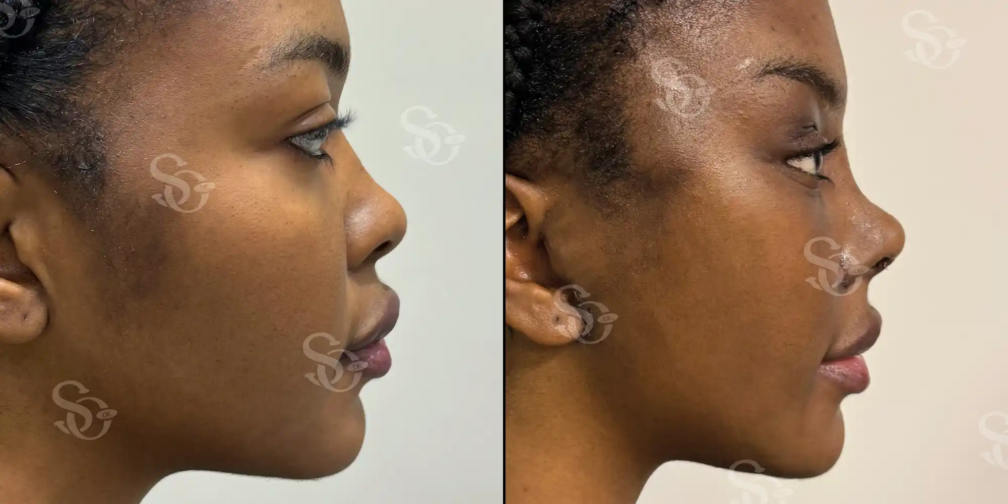 Etnik Rinoplasti 5 Rhinoplasty before after turkey 5 1