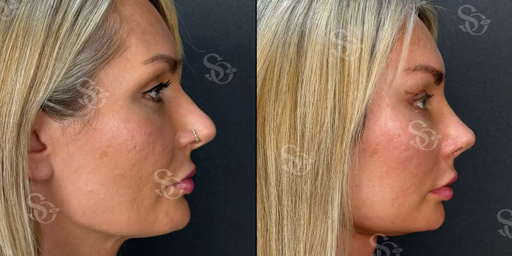 Rhinoplasty before after turkey 6