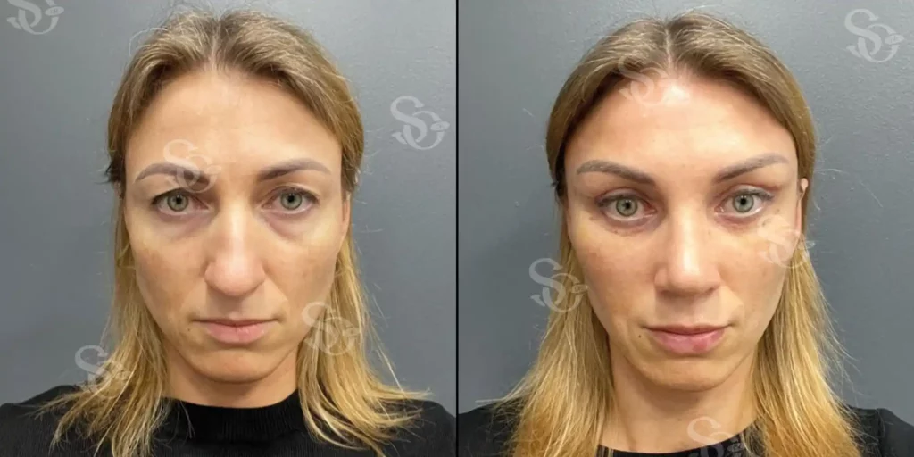 Temporal lift before after turkey istanbul 2 1024x512 2