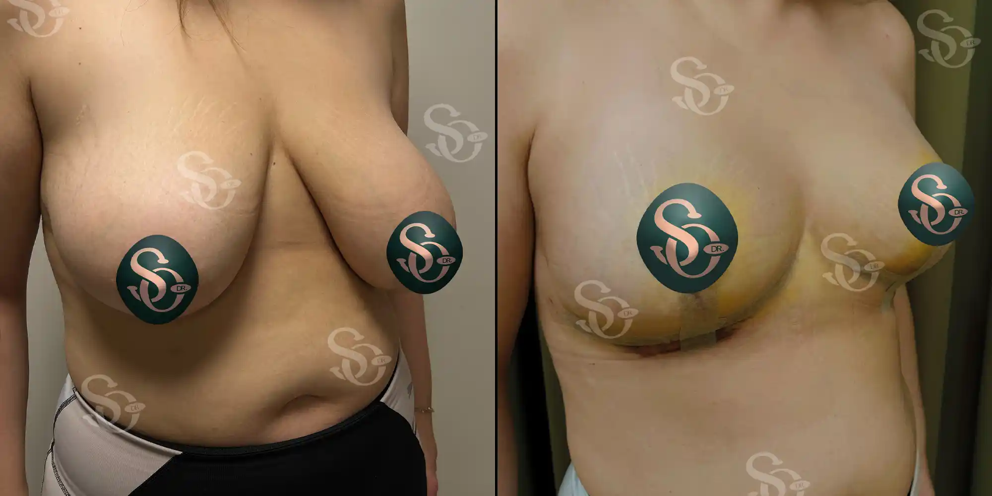Reducción mamaria 3 breast reduction before and after results in Turkey 1