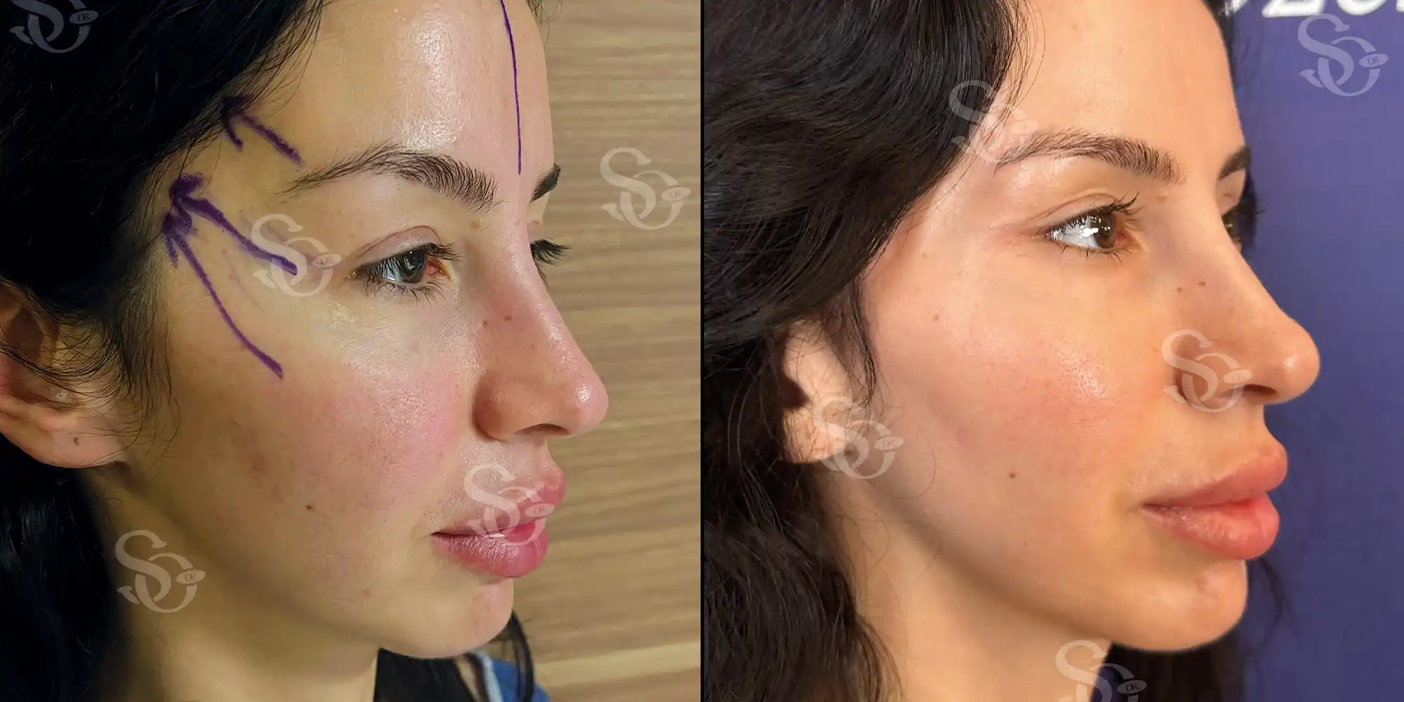 Lifting facial 3 facelift before after 1