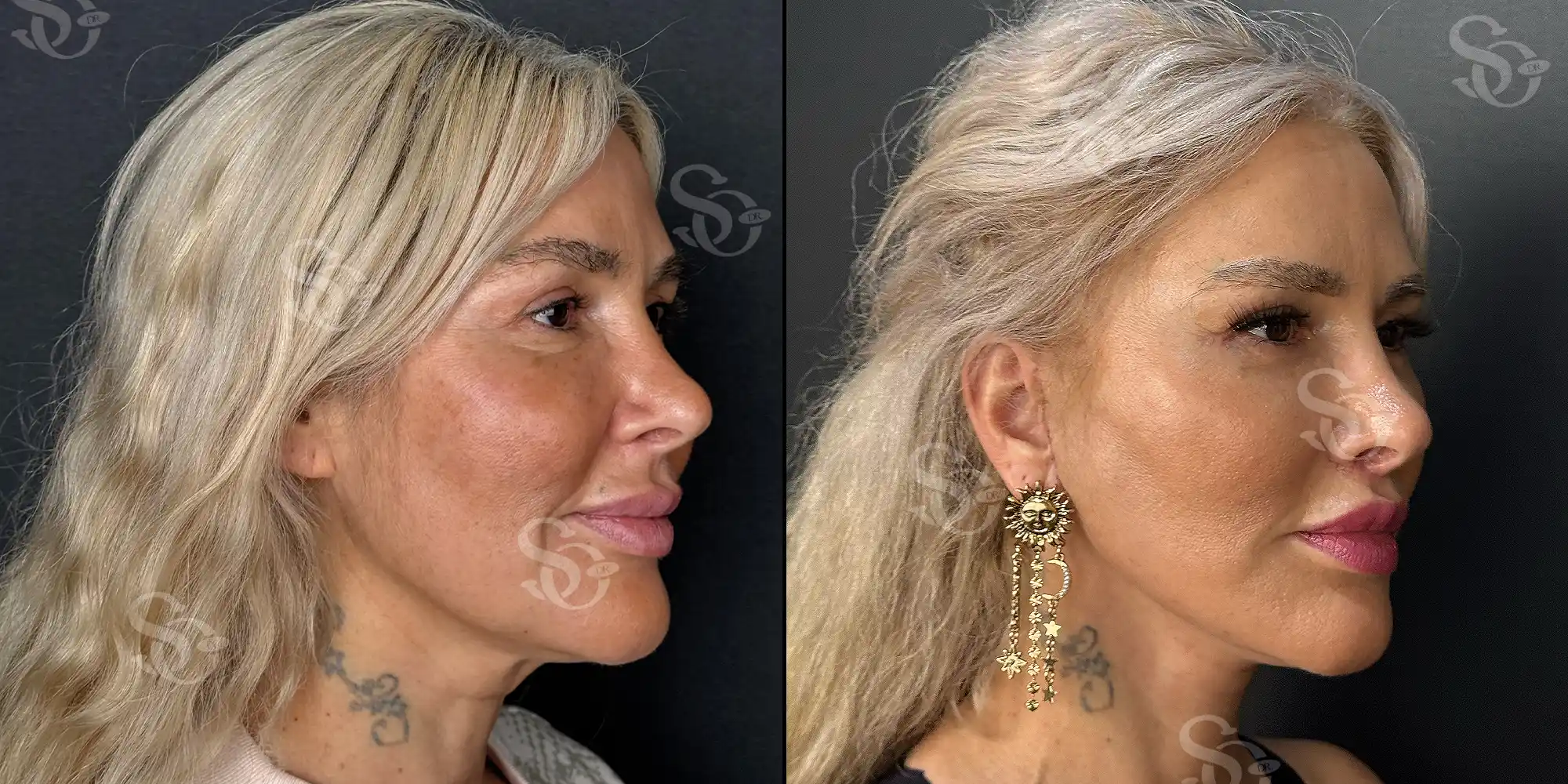 Lifting facial 2 facelift before after 3