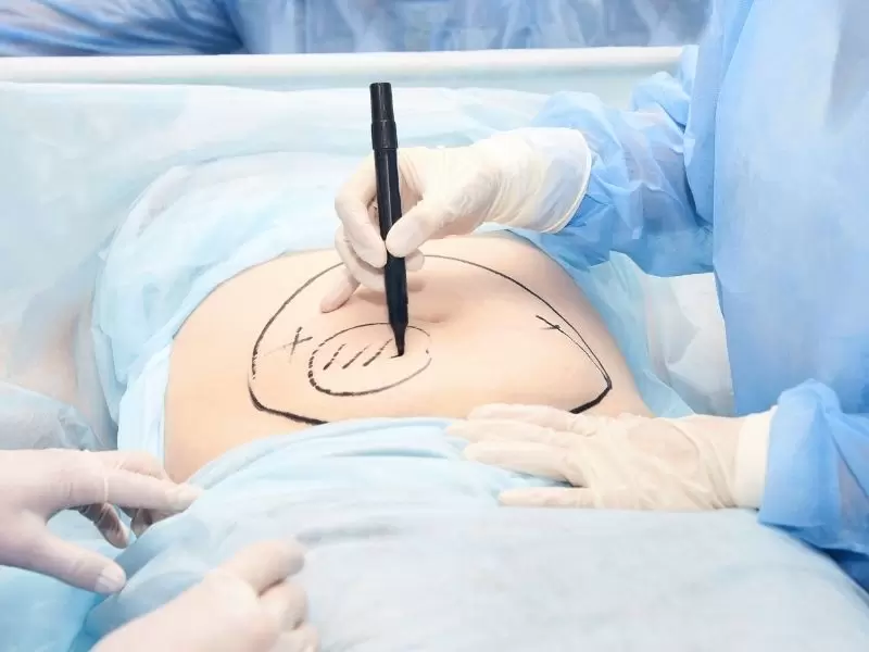 liposuction
