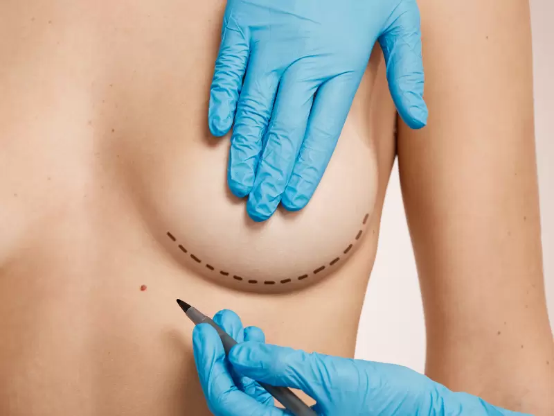 pregnancy after breast aesthetic surgery