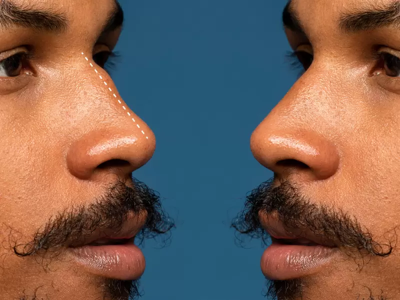 Rhinoplasty for Men 1 rhinoplasty for men