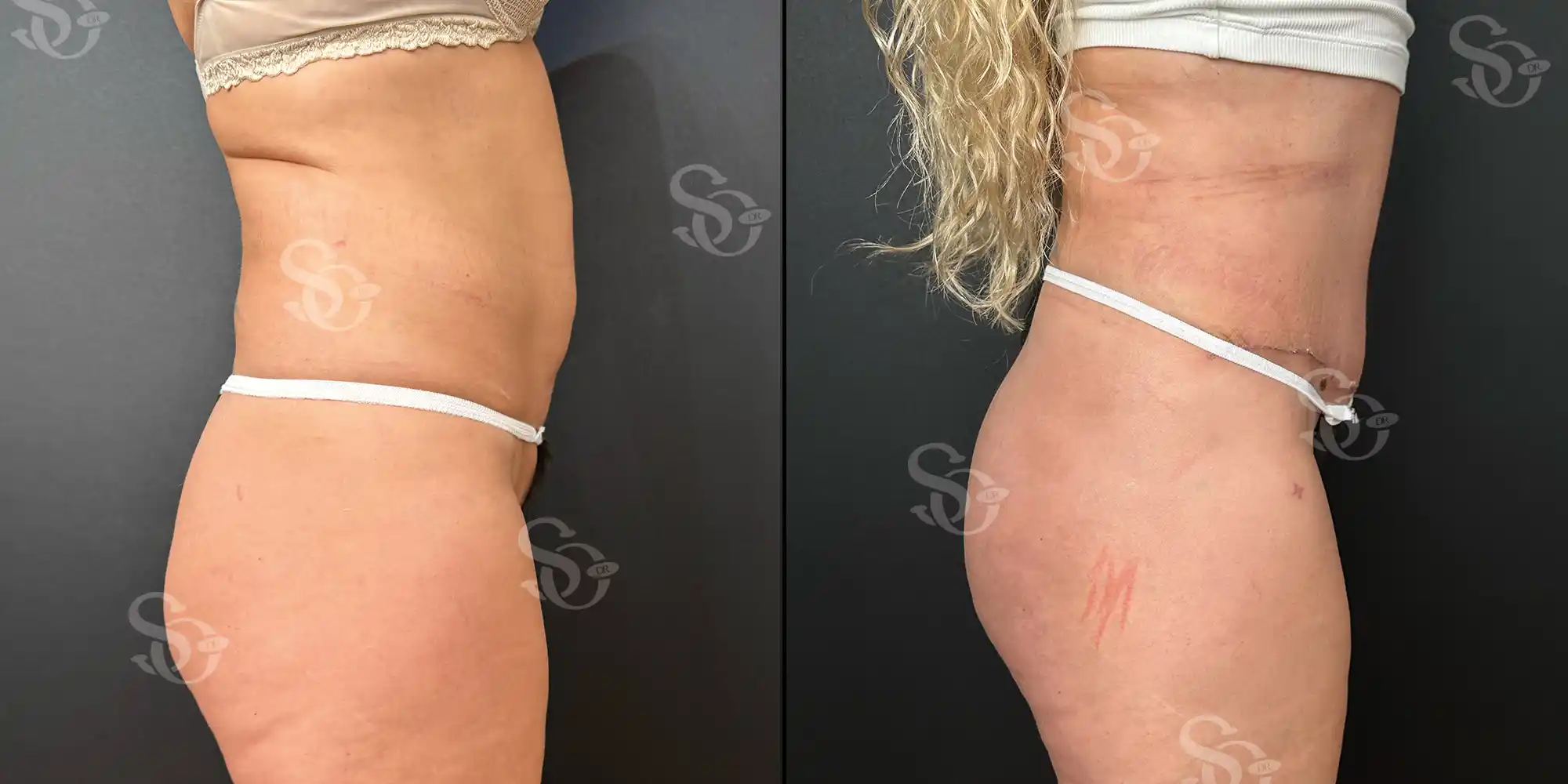 Plastie abdominale 4 tummy tuck abdominoplasty before and after results in Turkey 2