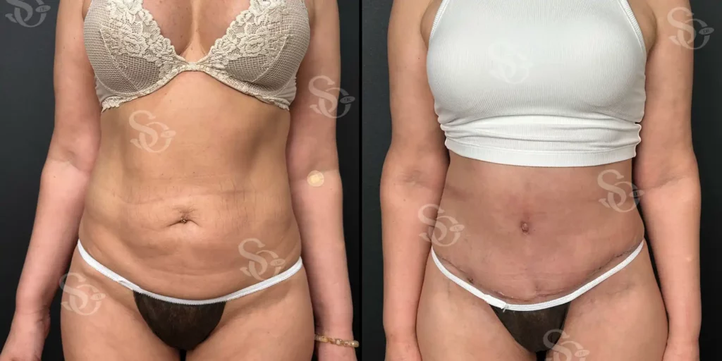Body Aesthetic Before After Istanbul Turkey 1 1024x512 4
