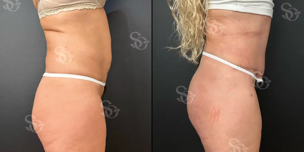 Body Aesthetic Before After Istanbul Turkey 2 1024x512 4