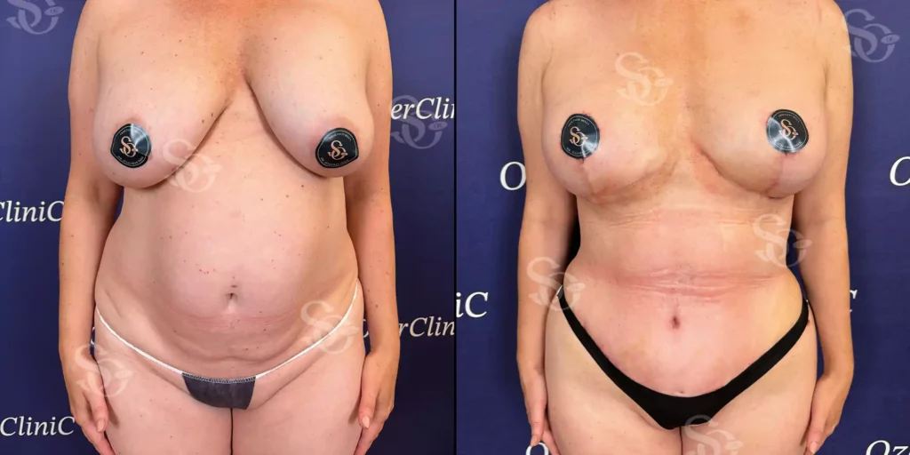 Body Aesthetic Before After Istanbul Turkey 3 1024x512 4