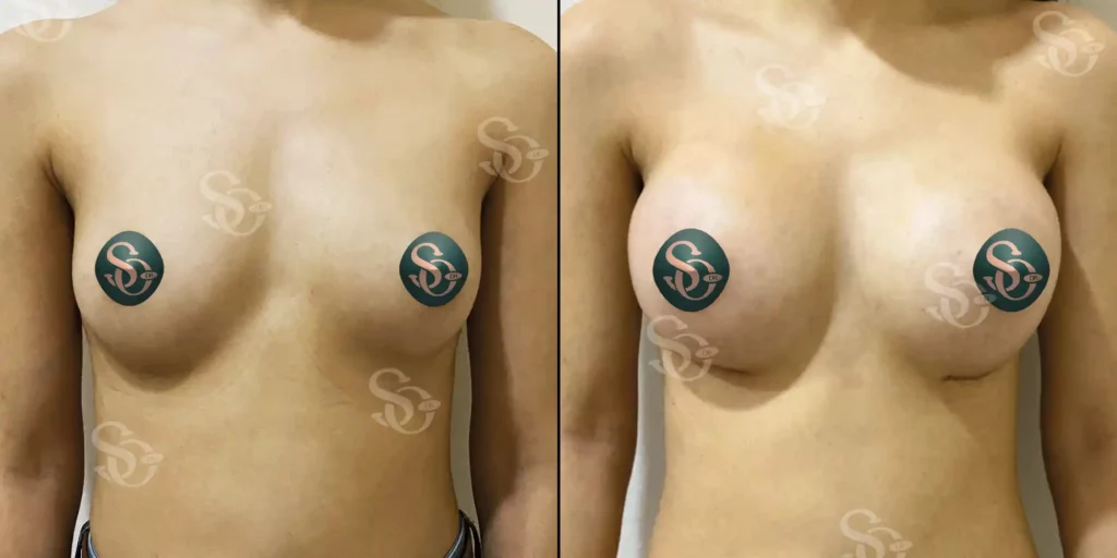 xBreast Implant Istanbul Turkey 3 1024x512 2.webp.pagespeed.ic .ZkcN7SHRdI 2