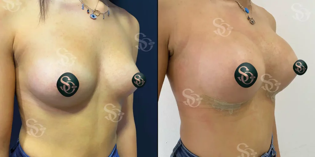 xBreast Implant Istanbul Turkey 4 1024x512 1.webp.pagespeed.ic .Yc13AS60OL 1
