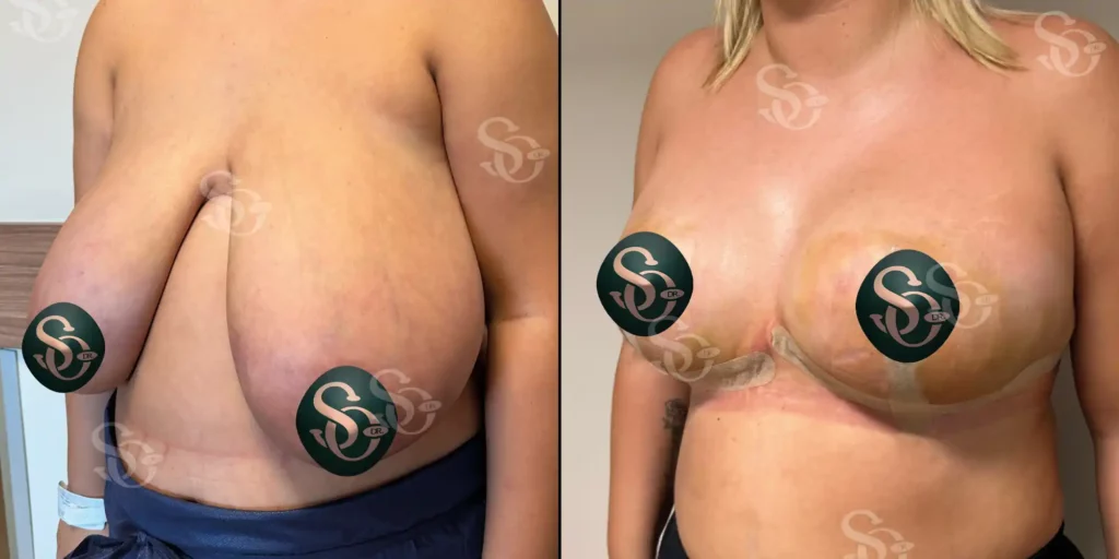 Breast Reduction Istanbul Turkey 1 1 1024x512 4