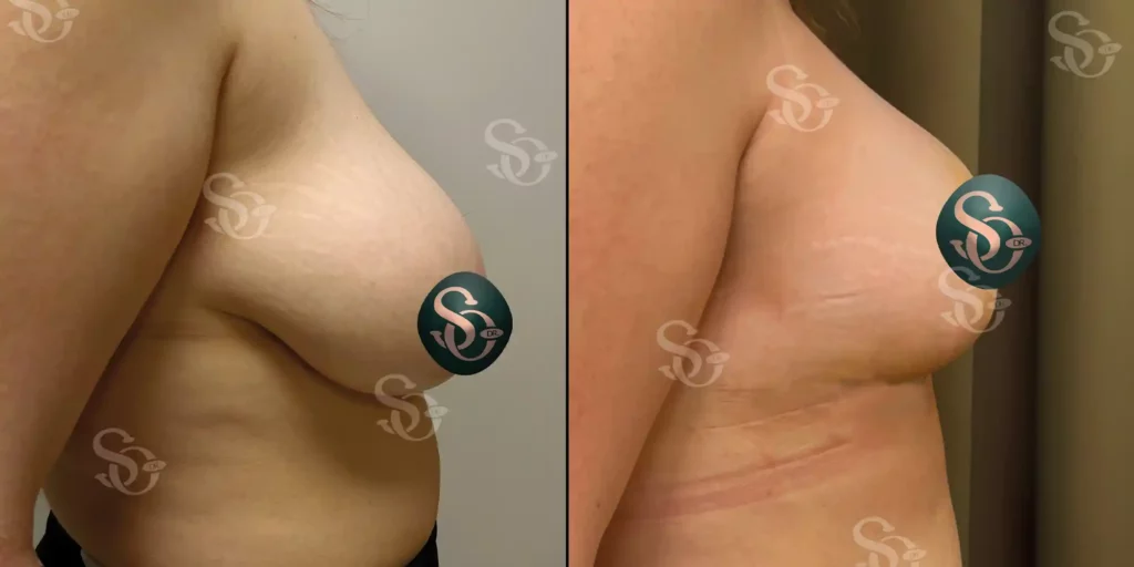 Breast Reduction Istanbul Turkey 2 1 1024x512 5