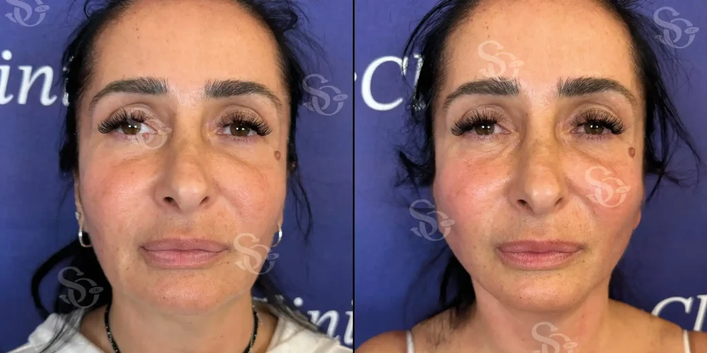 Istanbul turkey Facelift before After 2