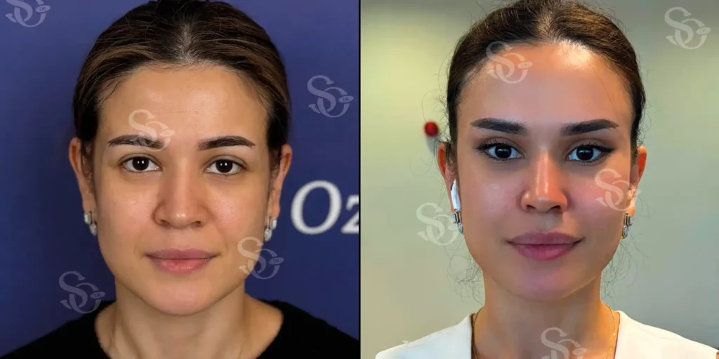 Temporal lift before after turkey istanbul 1 1024x512 2