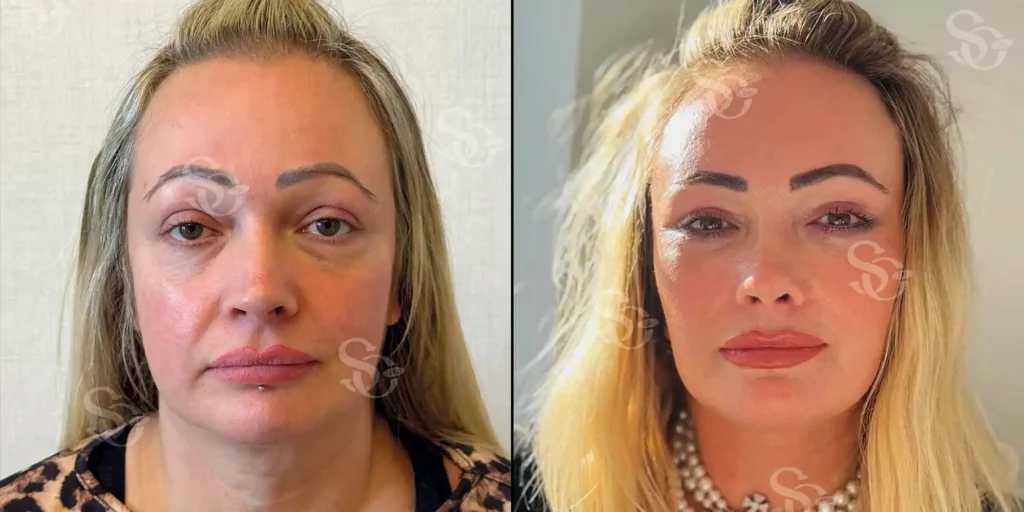 Temporal lift before after turkey istanbul 4 1024x512 1