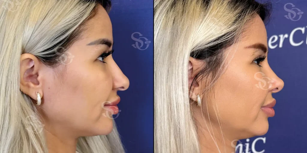 xTurkey Istanbul Rhinoplasty Before After 2 1024x512 2.webp.pagespeed.ic .APDjzezWSz 2