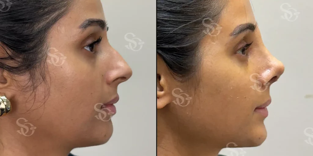 xTurkey Istanbul Rhinoplasty Before After 4 1024x512 3.webp.pagespeed.ic .SgFy9lLs Q 3