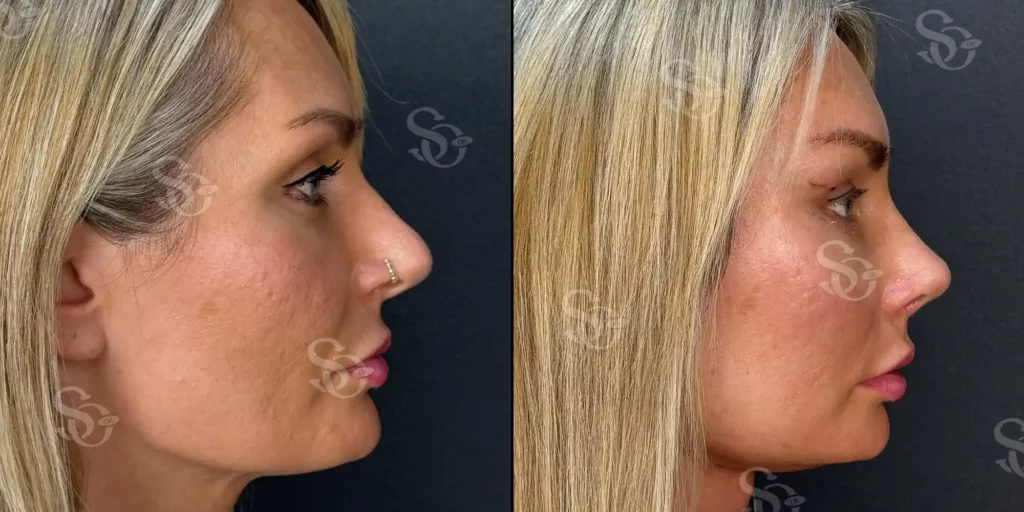 xTurkey Istanbul Rhinoplasty Before After 6
