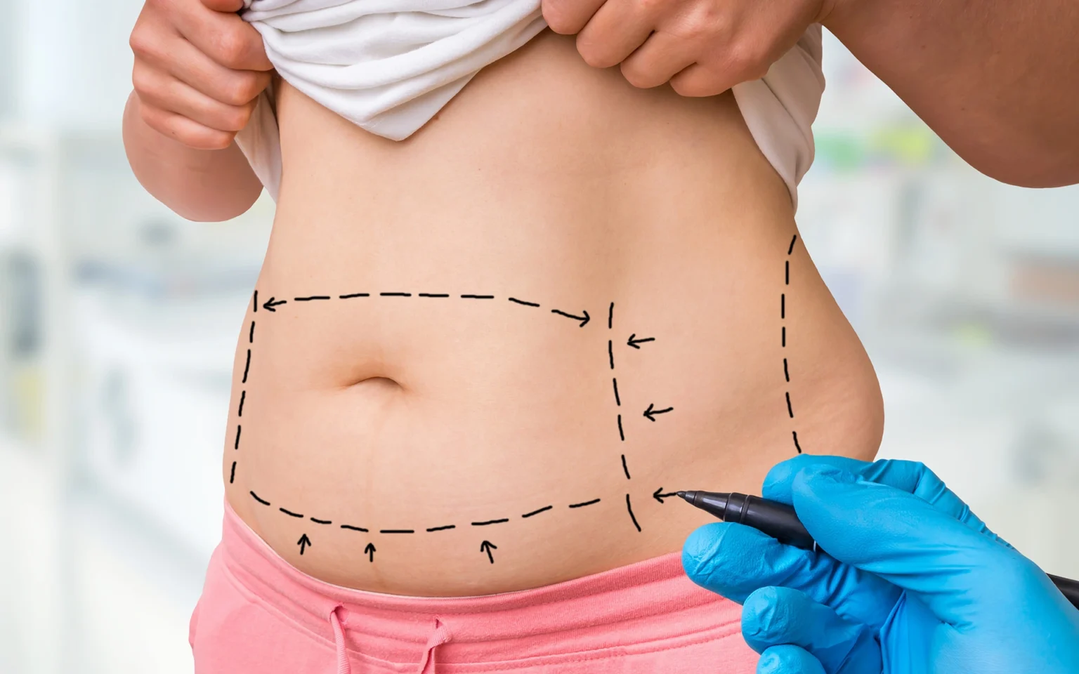 liposuction surgery 1536x960 1