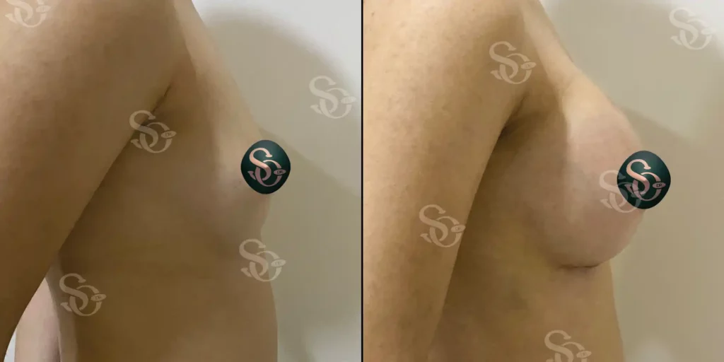 xBreast Implant Istanbul Turkey 2 1024x512 3.webp.pagespeed.ic .uMKYmLtT4d 3