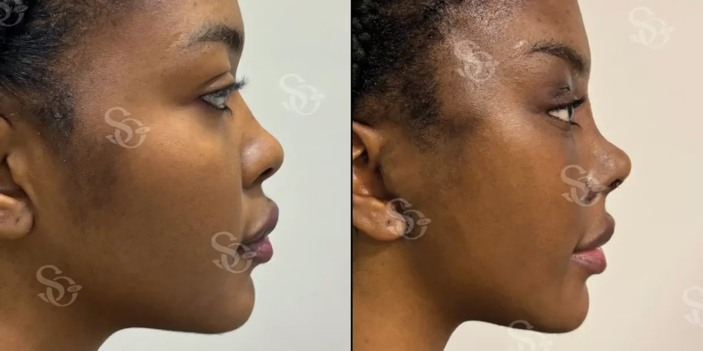 xTurkey Istanbul Rhinoplasty Before After 5 1024x512 3.webp.pagespeed.ic .RDsYnJQtAy 3