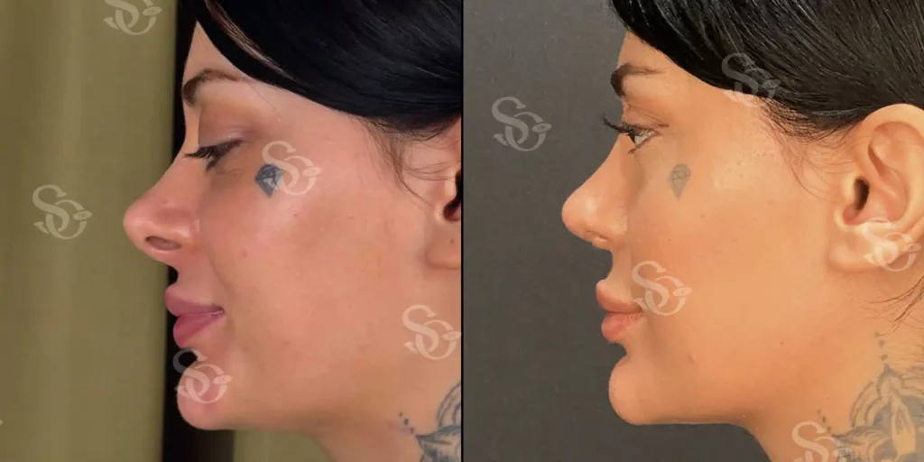 xTurkey Istanbul Rhinoplasty Before After 7 1024x512 3.webp.pagespeed.ic .OVSWBsmuvA 3