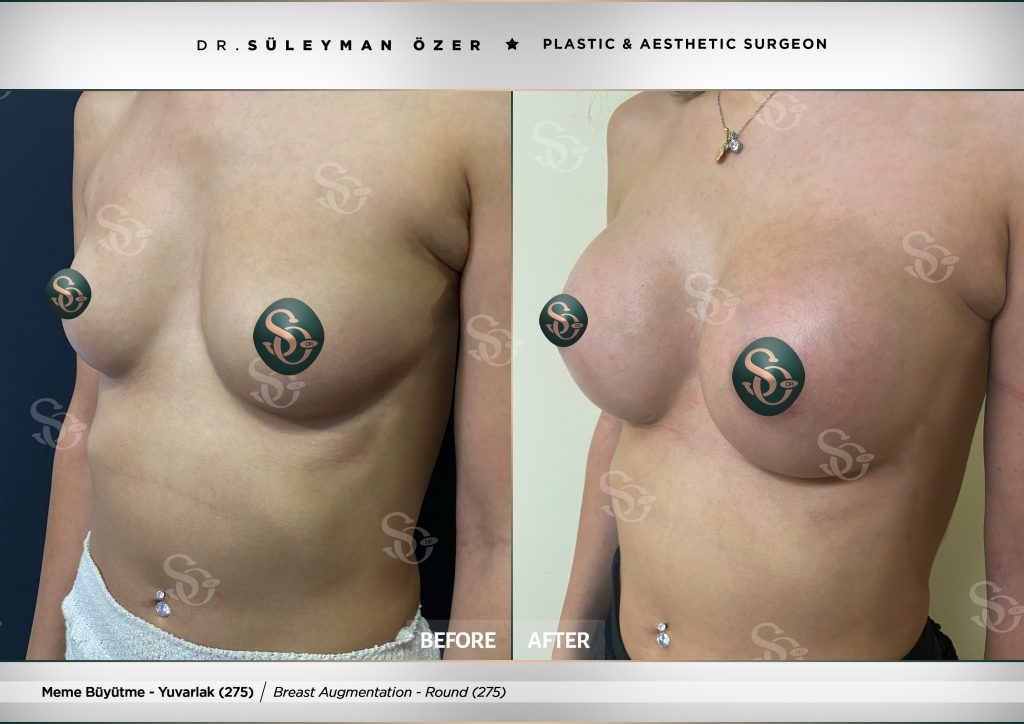 Before & After 20 breast augmentation before after round implant 275cc 2