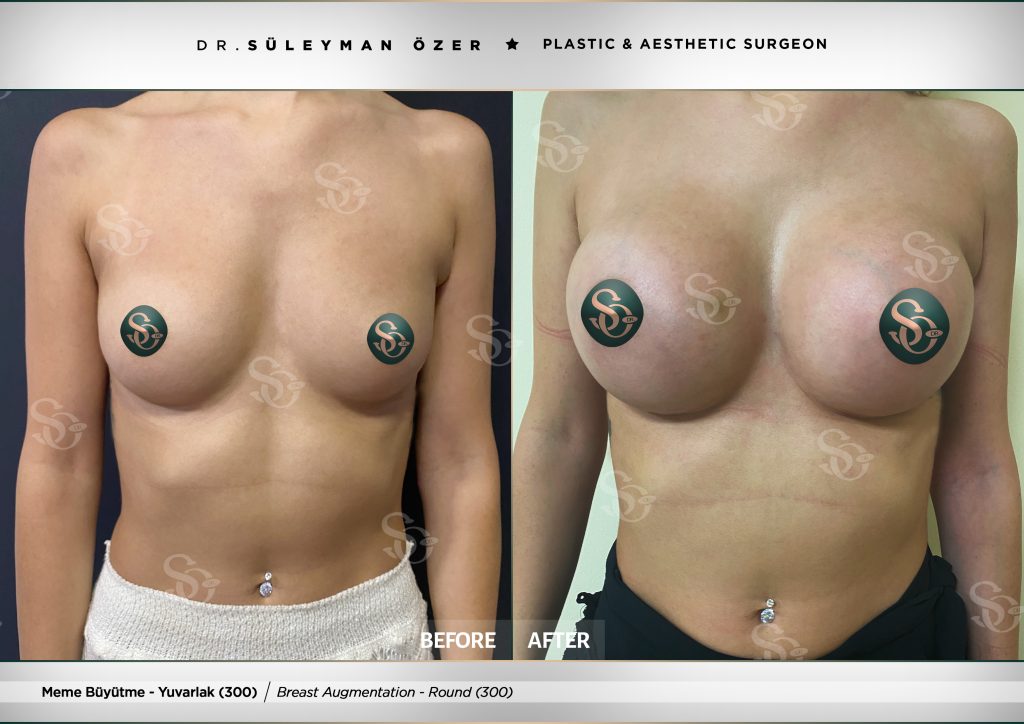 Before & After 21 breast augmentation before after round implant 300cc 1