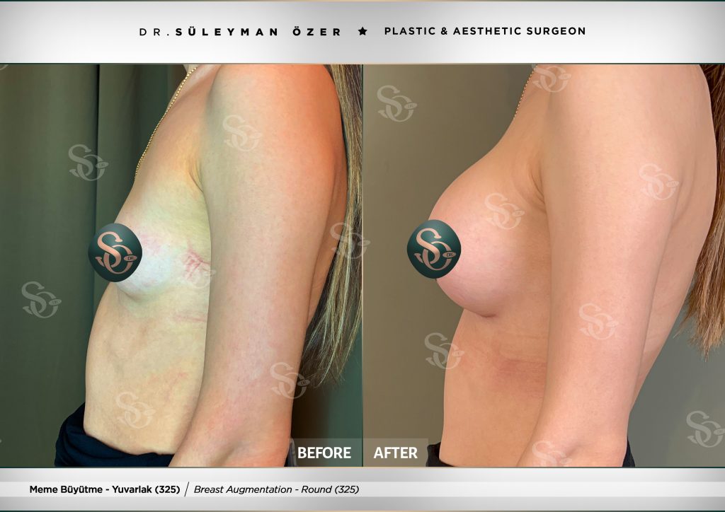 Before & After 22 breast augmentation before after round implant 325cc 1