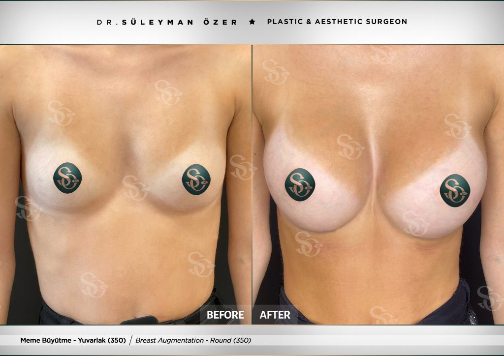 Before & After 23 Before and after breast augmentation with 350 cc round implants