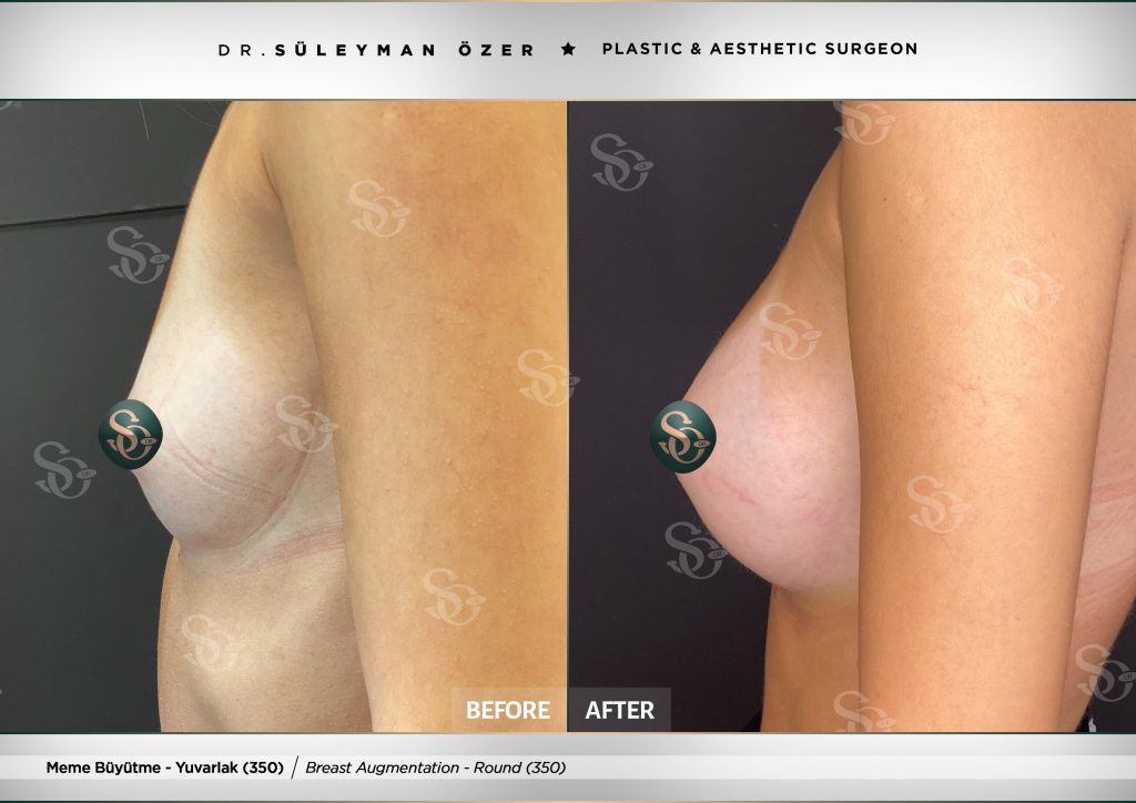 Before & After 24 Before and after breast augmentation with 350 cc round implants