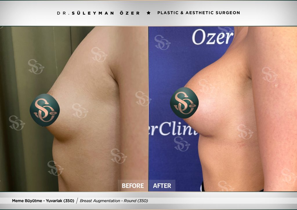 Before & After 25 Before and after breast augmentation with 350 cc round implants