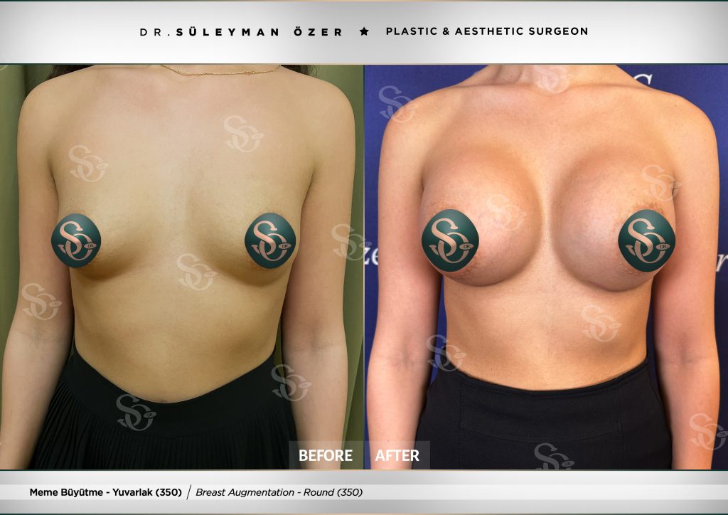 Before & After 26 Before and after breast augmentation with 350 cc round implants