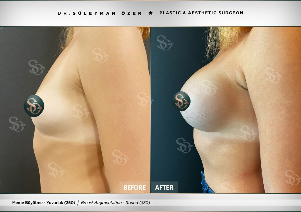 Before & After 27 Before and after breast augmentation with 350 cc round implants