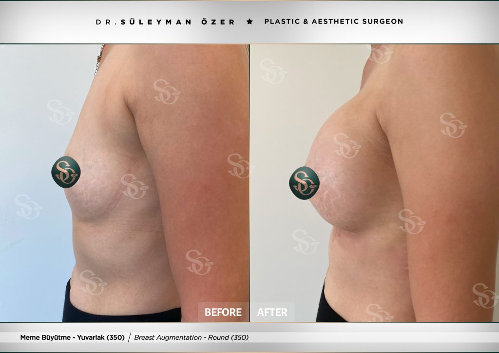 Before & After 28 Before and after breast augmentation with 350 cc round implants